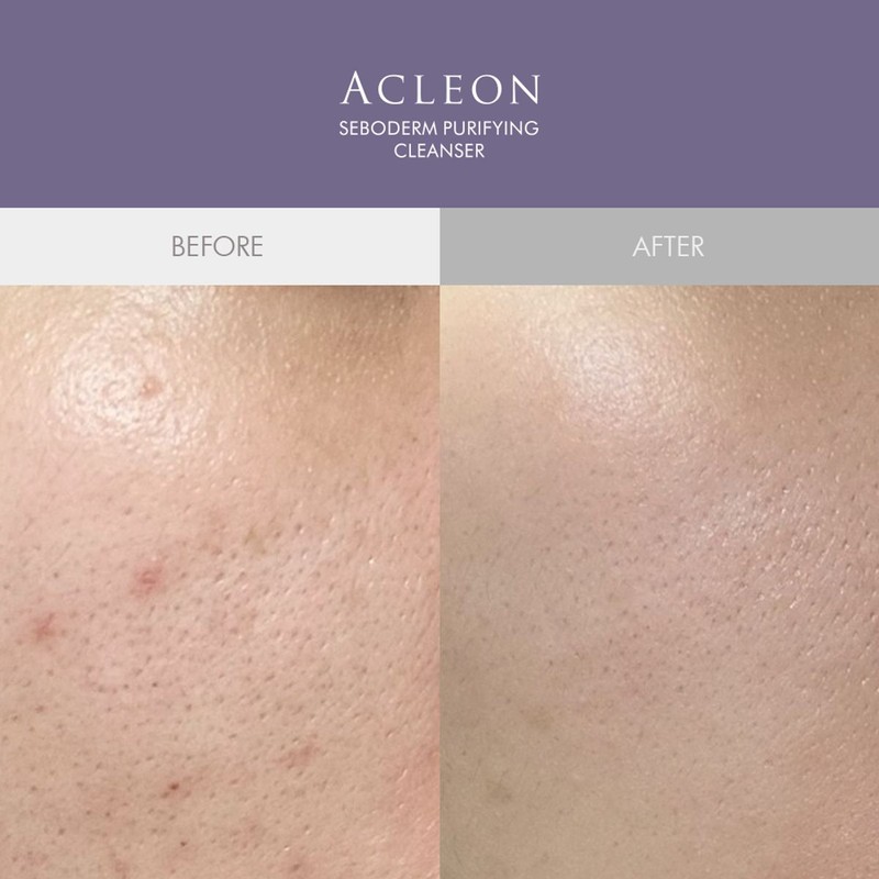 Acleon Anasis Mildly Alkaline Cleansing Foam Acne Treatment 2 Types
