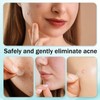 443PCS Pimple Patches 5 Sizes Acne Patches Hydrocolloid Acne Stickers