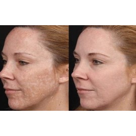 LasmaX-Skin LamaXSkin 4%Dark Skin Whitening Dark spot Brightening Lightening Face/body Cream