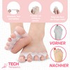 TECH THERAPEUTICS - Day and Night Complete Bunion Corrector Set