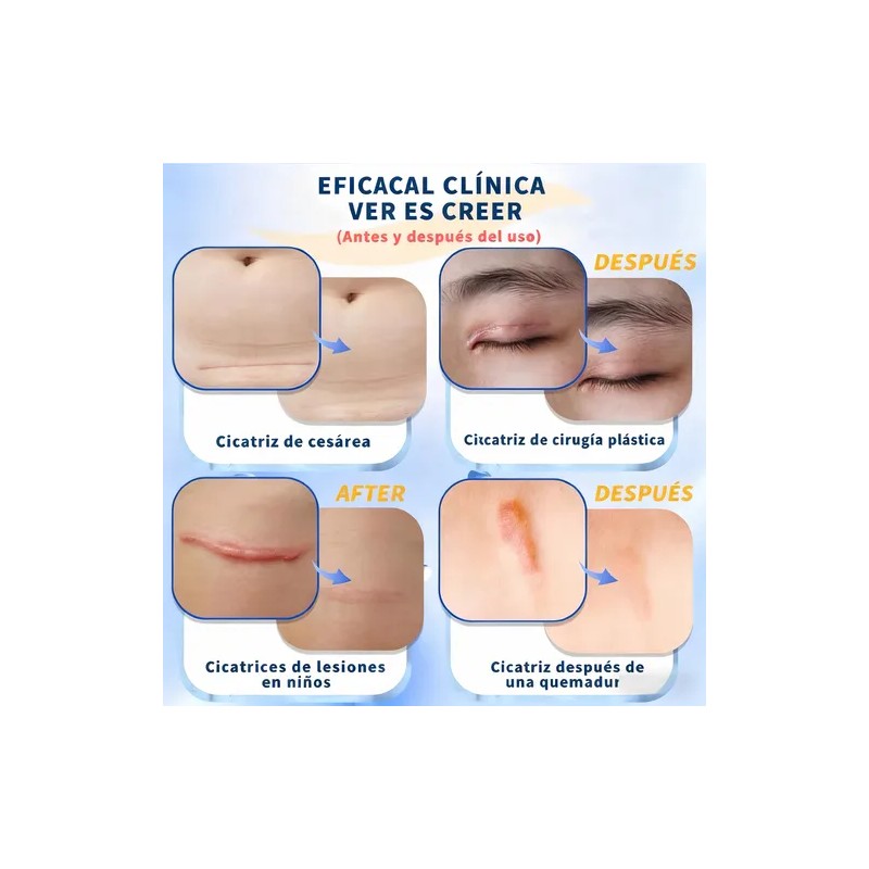 2pcsgel Para Las Cicatrices Momento De Aplicacin Noche Tipo