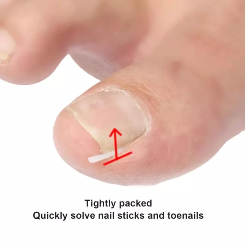 10 Pcs Ingrown Toenail Correction Strips Brace Kit, Ingrown Toenail