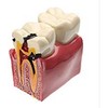 YOUYA - Modelo dental de caries dentales, modelo de estudio comparativo de dientes de caries dentales, 6 veces
