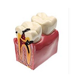 YOUYA - Modelo dental de caries dentales, modelo de estudio comparativo de dientes de caries dentales, 6 veces