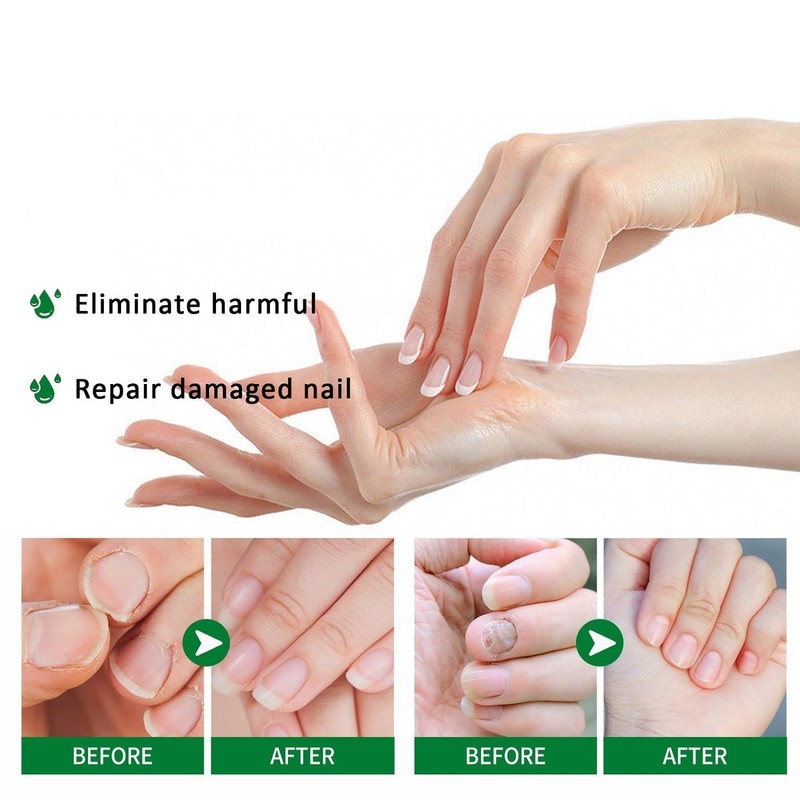Ginger Nail, Tratamiento de Uñas con Jengibre, Soporte para Uñas,