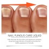Líquido Para Hongos En Uñas - Cura Hongos Y Onicomicosis