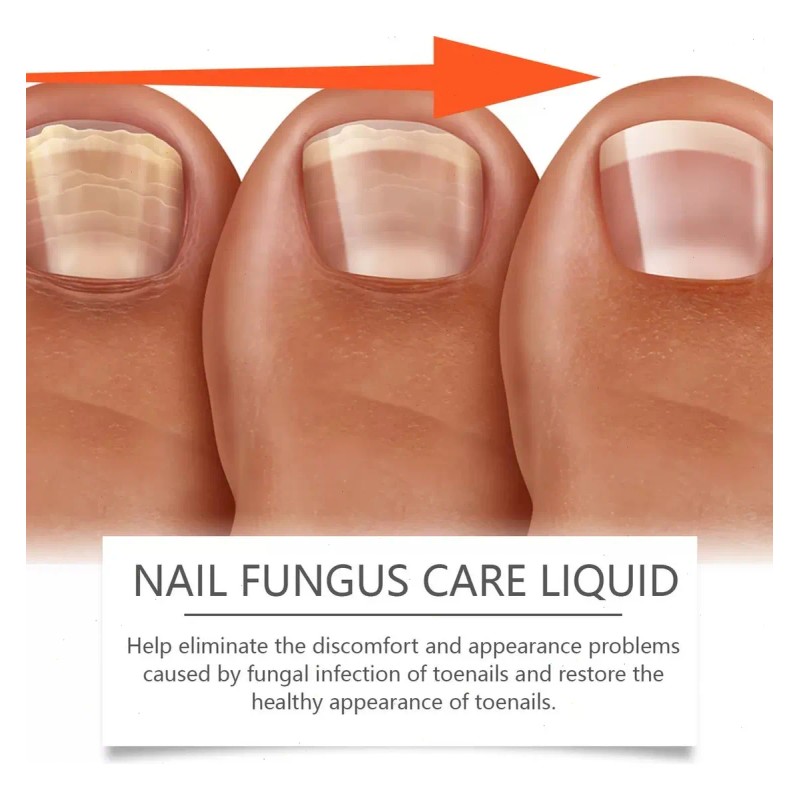 Líquido Para Hongos En Uñas - Cura Hongos Y Onicomicosis