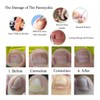 Professional Toenail Correction Paronychia Nail Sticker Correction Ingrown Pincer Toenail