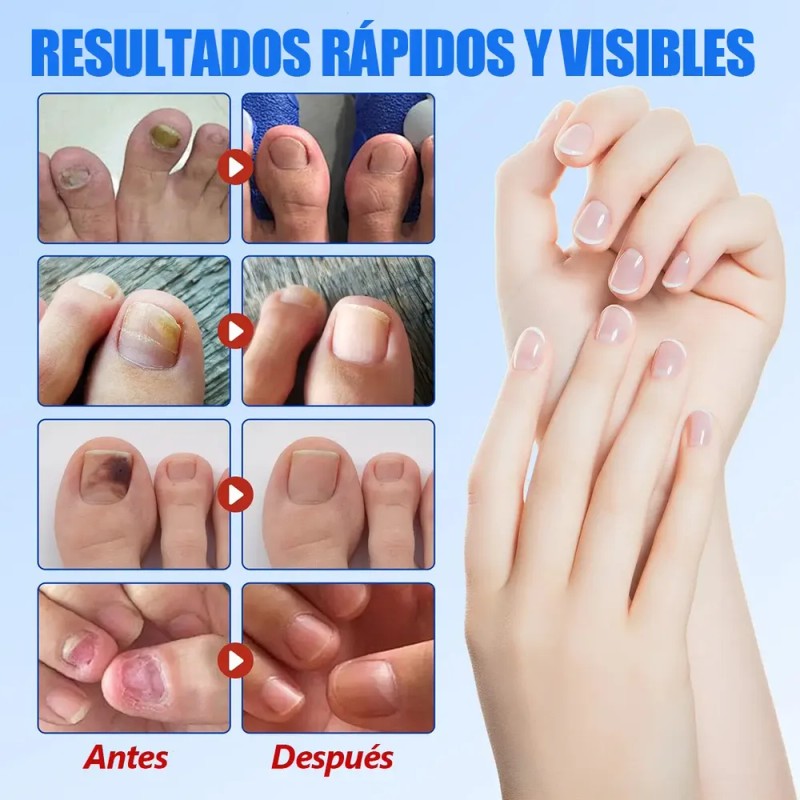 Parches Para Uñas Fúngicos 63pzs Caja De Parches Dañadas