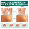 Airroye 1 Roll Silicone Adhesive Scar Sheets 1.6" x 120