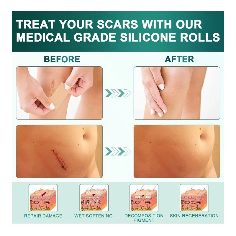 Airroye 1 Roll Silicone Adhesive Scar Sheets 1.6" x 120