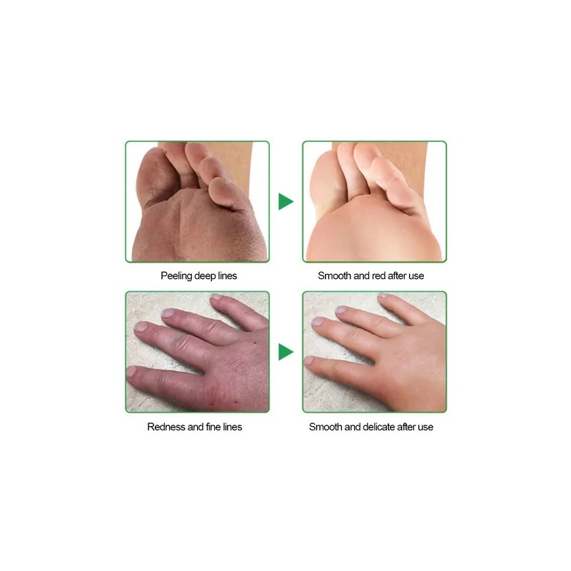 Crema Hidratante Para Manos Y Pies Para Grietas
