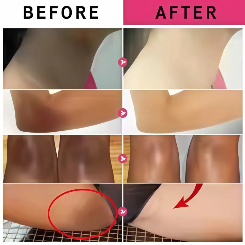Adecuado Para Manchas, Cloasma Y Acné. Crema Antipecas.