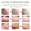 Crema Facial Antiacné, Elimina Profesionalmente Las Marcas D