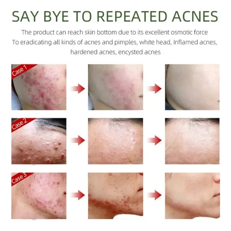 Crema Facial Antiacné, Elimina Profesionalmente Las Marcas D