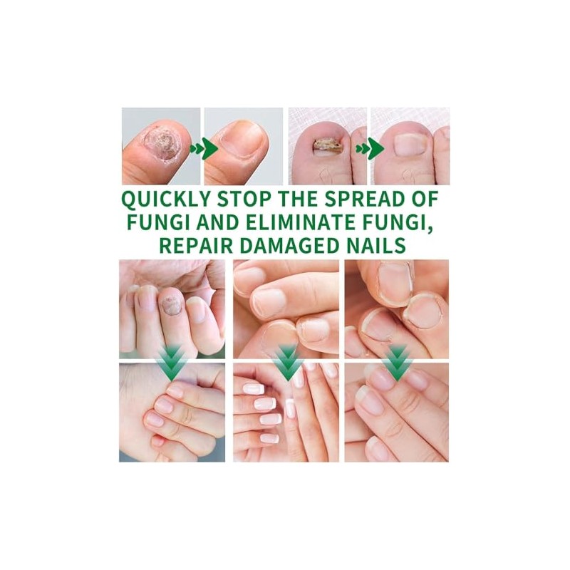 Ginger Nail, Tratamiento de Uñas con Jengibre, Soporte para Uñas