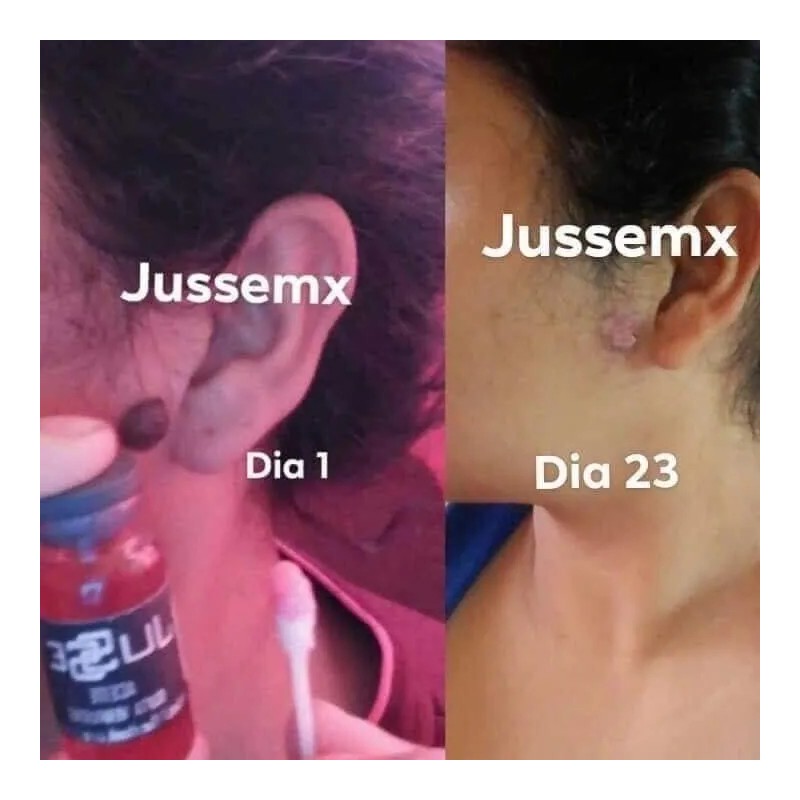 Jusse Anti Verrugas Lunares Mezquinos 15 Ml Sin Perfumar