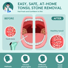 Alitake Electronic Vacuum Tonsil Stone Removal Kit - Tonsil Stone Remover with Built-in LED Light 3 Suction Mode - Fight Bad Breath Oral Irrigator 5X Magnifying Mirror for Stone Removal (Green)