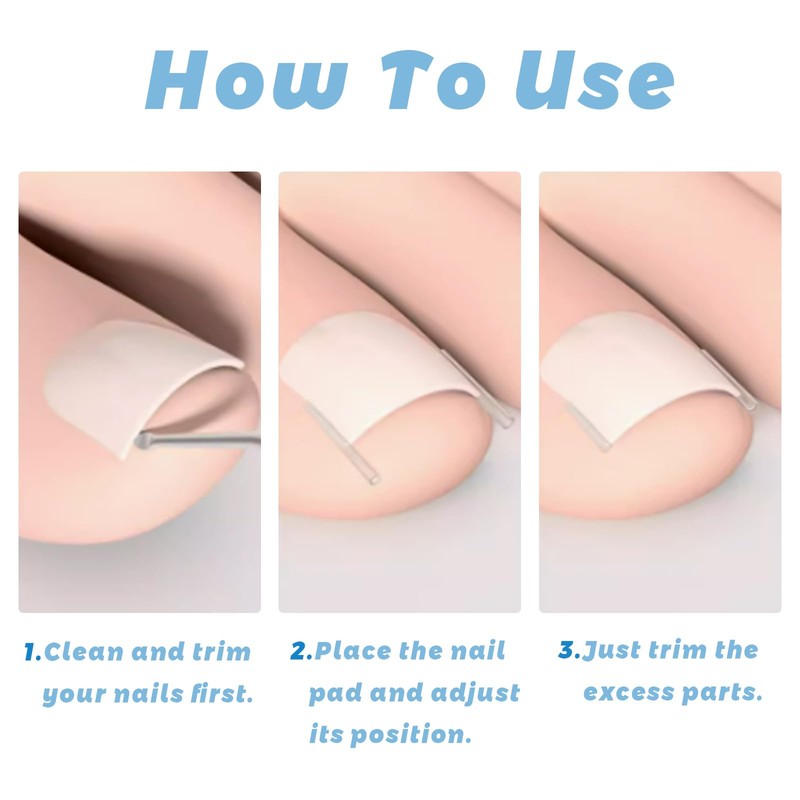 101 Pcs Ingrown Toenail Treatment Set, Clear Ingrown Toenail Corrector
