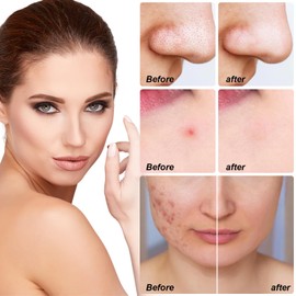 Tkekruh Pimple Patch, Pack of 10, Breakout Pimple Patches, Pimple Plasters, Thicker, Extra Adhesion, Hautfreundliches Akne-Pflaster, Effektiv Gegen Akne und Pimples, Acne Absorbing Cover, Face Mask