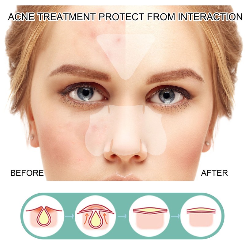 396Pcs Blemish Patches Facial Pimple Zit Spot Stickers Mild Non