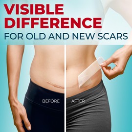 Medical Grade Silicone Scar Sheets - Transparent - 4pk (5.7”x1.6”) - Visible Difference on Surgical & Keloid Scars - Reusable C-Section Scar Silicone Strips - Easy to Use Silicone Sheets for Scars