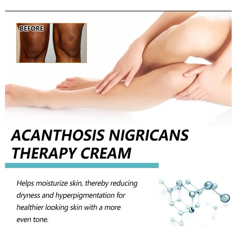 Crema 3× Para Acantosis Nigricans Fbg 50g