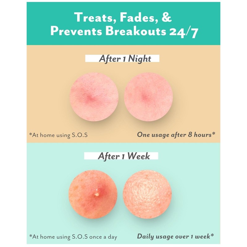 Patchology S.O.S. Overnight Acne Solution, Gel-to-Patch – Clarifying Liquid Patch