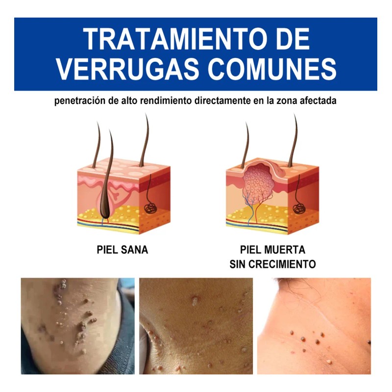 Líquido De Eliminación De Verrugas Plantar Y Comunes 1pc