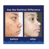 Panoxyl Acné Foaming Wash 10% Peróxido De Benzoilo 156 G