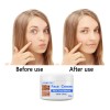 Crema Aclaradora Facial Moteada 50 G, Melasma Speckle Moistu