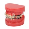 Professional Dental Demonstration Orthodontic Model with Metal Wires and Bracket