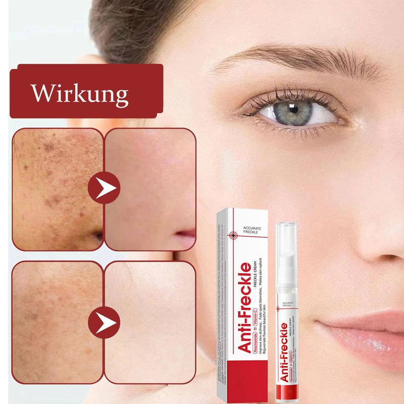 Soleneva 2PCS Pigmentflecken Entferner Gesicht, Creme Gegen Pigmentflecken & Altersflecken,