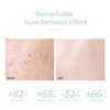 Skin Care Serum Plants Extracts Reduce Pimples Prevent Swelling Redness