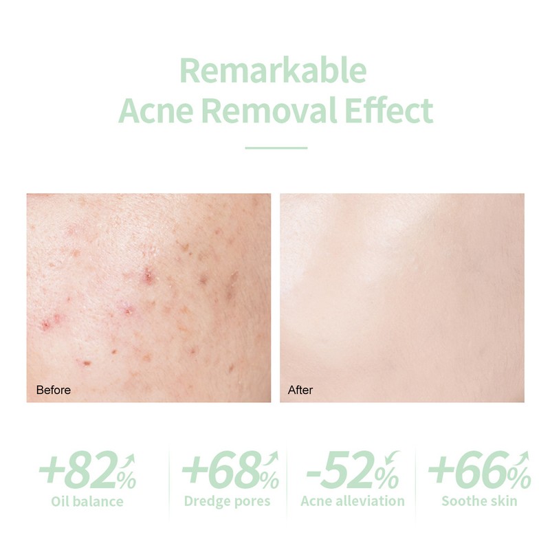 Skin Care Serum Plants Extracts Reduce Pimples Prevent Swelling Redness