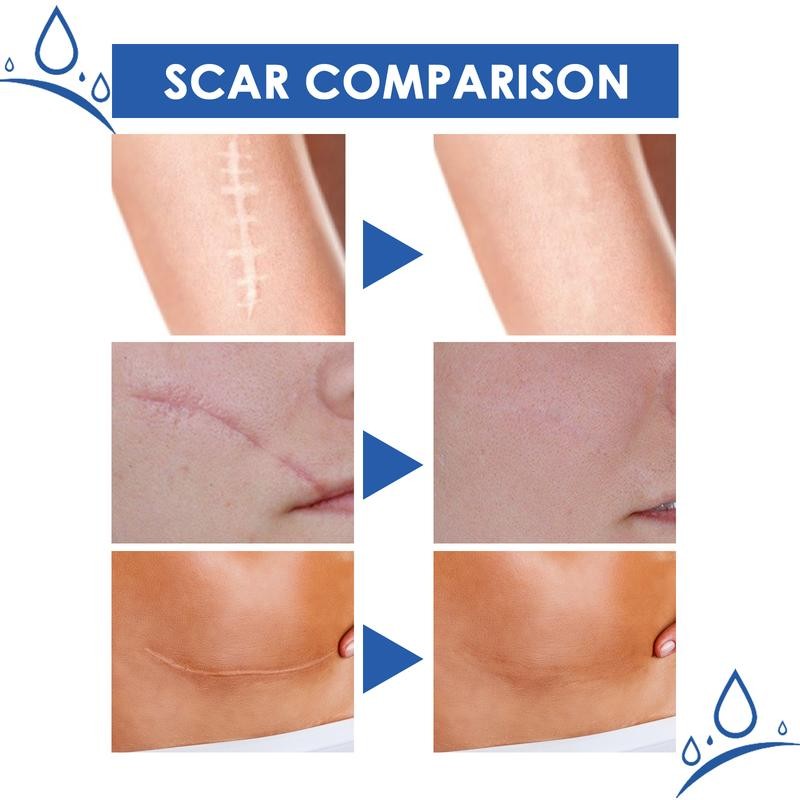 Professional Scar Removal Gel- Scarremoval treatment for keloids, C-sectionS, surgeries,
