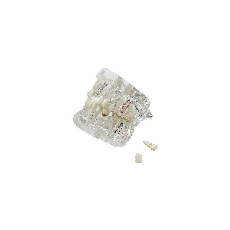Modelo de implante de dientes, para enseñanza, modelo de enfermedad,