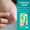 Crema Para Psoriasis Y Eczema, Crema Natural A Base De