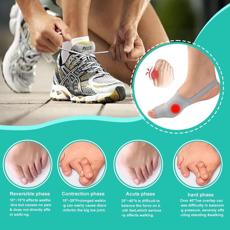 Hallux Valgus Socks, Hallux Valgus Bandage, Hallux Valgus Correction, Bunion