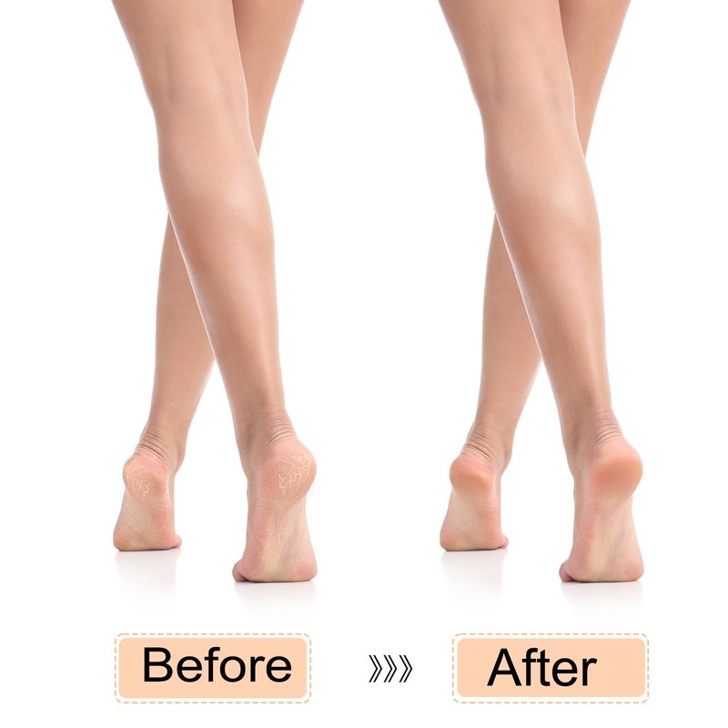 HARFINGTON 2pcs Foot Pumice Stone for Feet Hard Skin Remover,