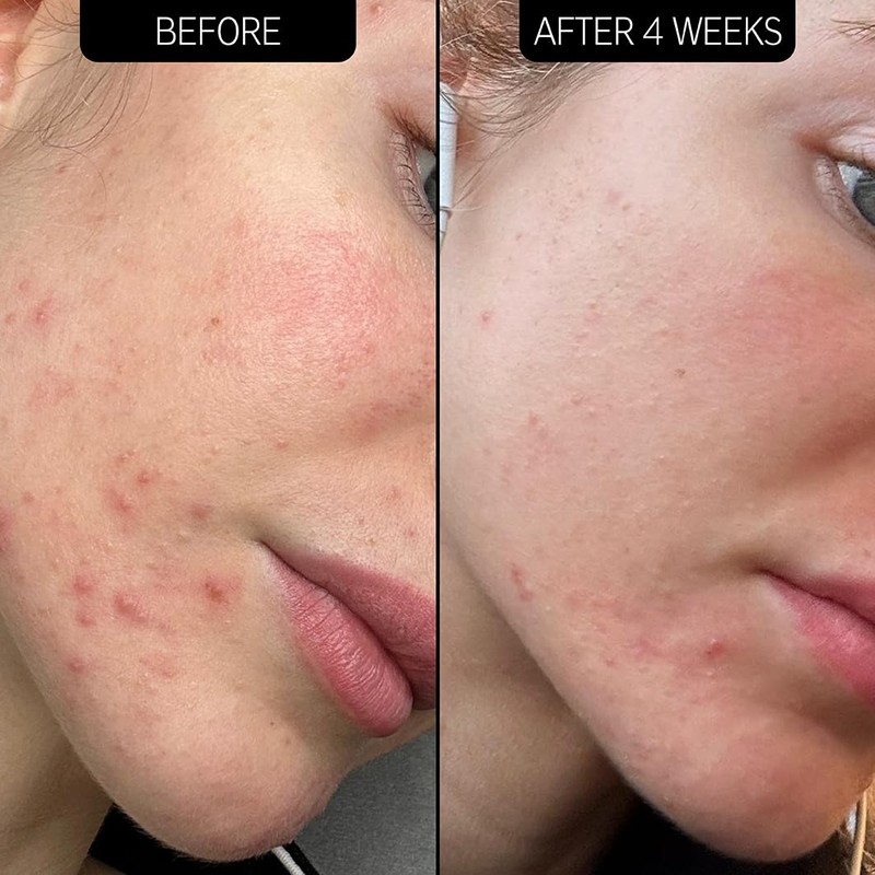 The Inkey List Blemish Clearing Moisturiser 50ml | Dermatologically Tested