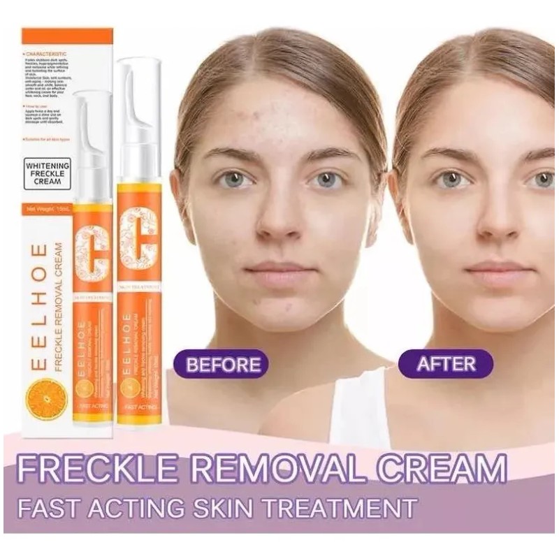Crema Elimina Manchas De Acné De Sol Pecas Paño Melasma