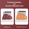 Simedutech Silicone Alcoholic Fatty Liver Model, Pathological Liver Replica for