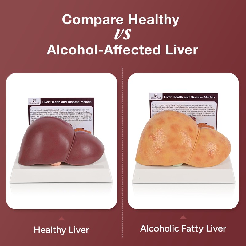 Simedutech Silicone Alcoholic Fatty Liver Model, Pathological Liver Replica for