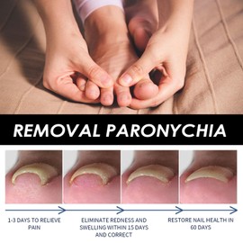 50pcs Ingrown Toenail Correction Patch,Nail Correction Sticker,Ingrown Toenail Sticker Patch,Ingrown Toenail Treatment,Ingrown Toenail Corrector Tool,Nail Correction Patches,Painless Toe Nail Stickers