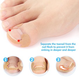 Yuerme 88Pcs Ingrown Toenail Treatment Patches and 10 Pcs C-pads, Ingrown Toenail Corrector for Nail Health with Ingrown Toenail Tool