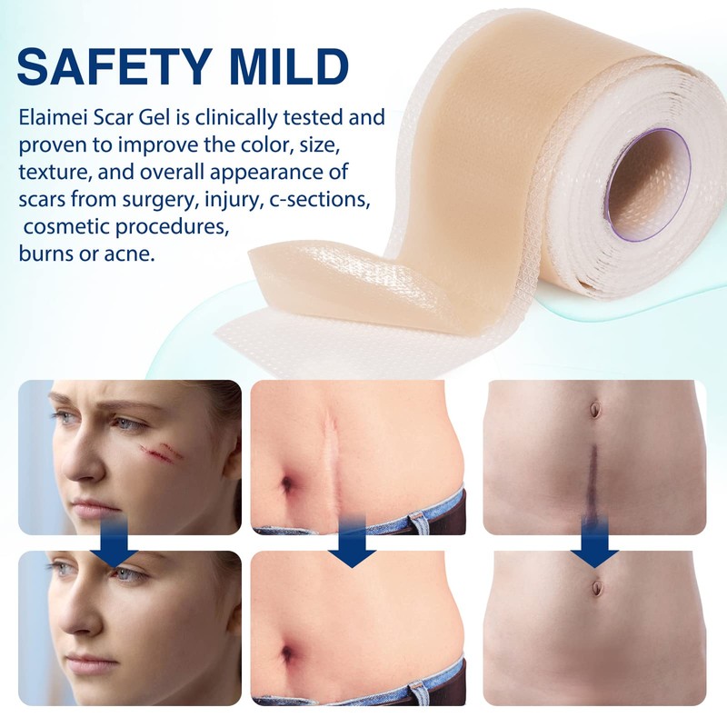 Silicone Scar Sheets (1.6”x 130”, 3.3M), Professional Silicone Scar Tape,
