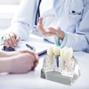 Ultrassist Modelo de implante dental, transparente