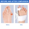 Giutsaull Hallux Valgus Korrektur Set, Verstellbarer Hallux Valgus Schiene, Ballenzeh-Fix