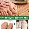 Ginger Nail, Tratamiento de Uñas con Jengibre, Soporte para Uñas,